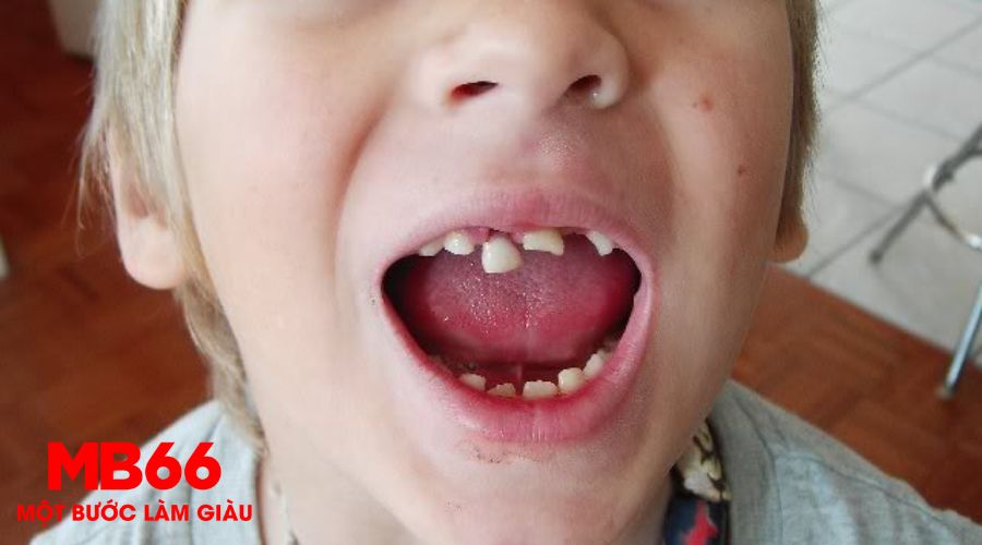 Mơ Thấy Rụng Răng Báo Hiệu Điềm Gì Và Nên Đánh Số Mấy? 2 Mơ thấy rụng răng bị chảy máu và ý nghĩa